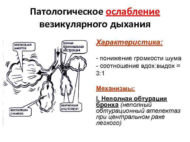 Патологическое ослабление везикулярного дыхания Характеристика: - понижение громкости шума - соотношение вдох: выдох =