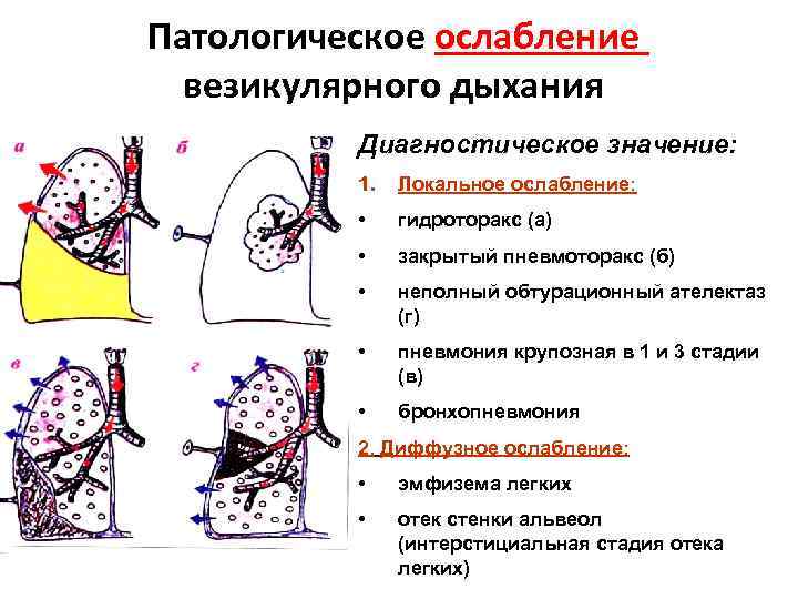 Патологическое ослабление везикулярного дыхания Диагностическое значение: 1. Локальное ослабление: • гидроторакс (а) • закрытый