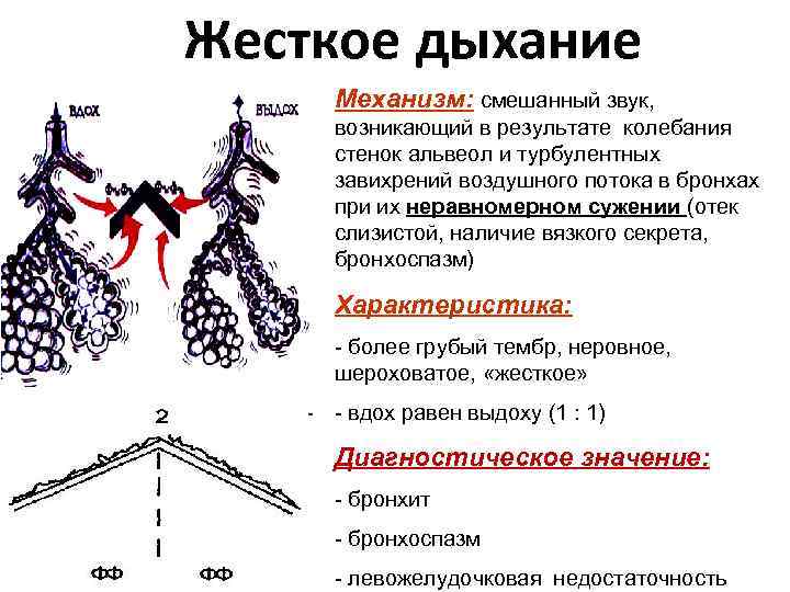 Жесткое дыхание Механизм: смешанный звук, возникающий в результате колебания стенок альвеол и турбулентных завихрений