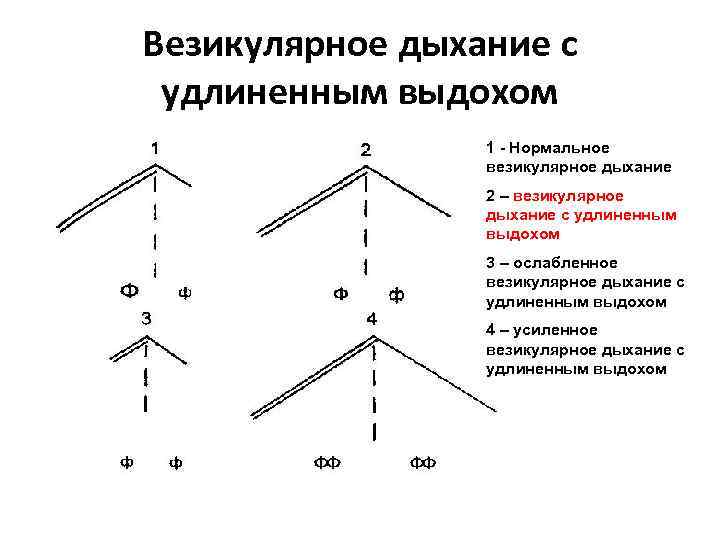 Везикулярное дыхание с удлиненным выдохом 1 - Нормальное везикулярное дыхание 2 – везикулярное дыхание