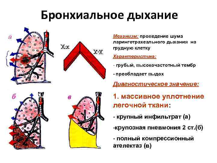 Бронхиальное дыхание а Механизм: проведение шума ларинготрахеального дыхания на грудную клетку Характеристика: - грубый,