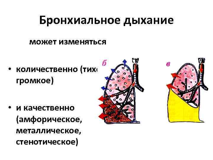 Бронхиальное дыхание. Стенотическое бронхиальное дыхание. Амфорическое бронхиальное дыхание. Инфильтративное бронхиальное дыхание. Разновидности бронхиального дыхания.