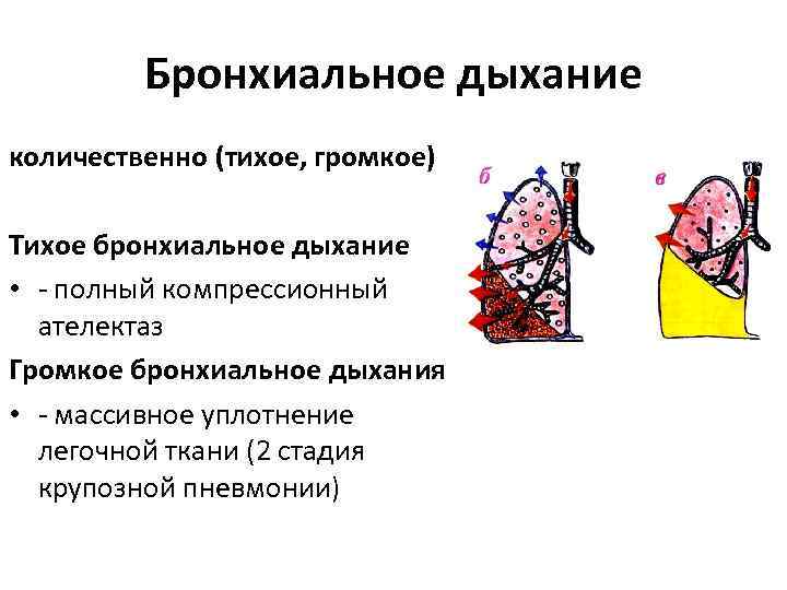 Бронхиальное дыхание количественно (тихое, громкое) Тихое бронхиальное дыхание • - полный компрессионный ателектаз Громкое