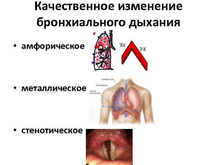 Качественное изменение бронхиального дыхания • амфорическое • металлическое • стенотическое 