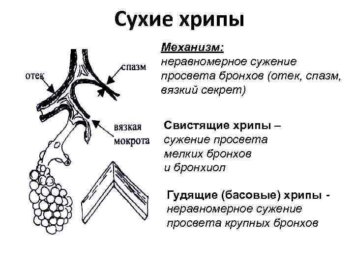 Сухие хрипы Механизм: неравномерное сужение просвета бронхов (отек, спазм, вязкий секрет) Свистящие хрипы –