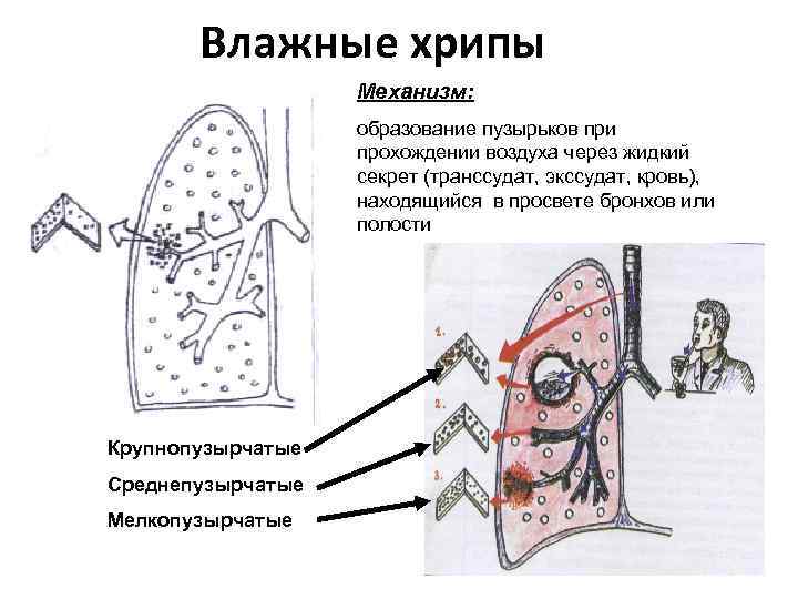 Влажные хрипы Механизм: образование пузырьков при прохождении воздуха через жидкий секрет (транссудат, экссудат, кровь),