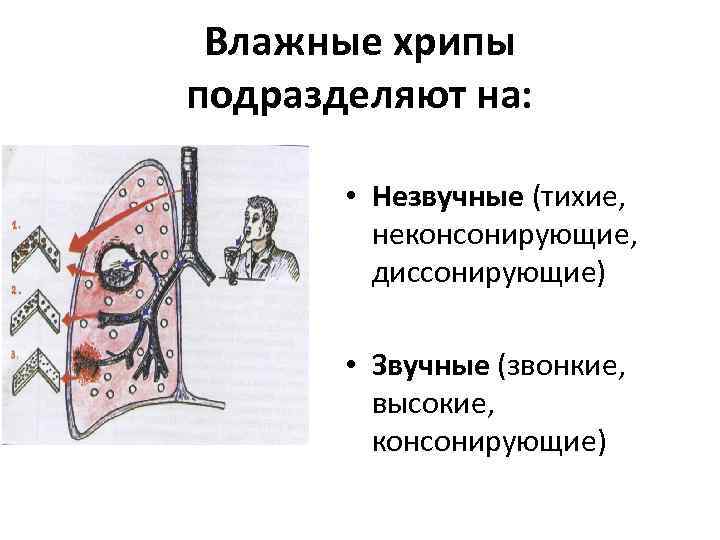 Влажные хрипы подразделяют на: • Незвучные (тихие, неконсонирующие, диссонирующие) • Звучные (звонкие, высокие, консонирующие)