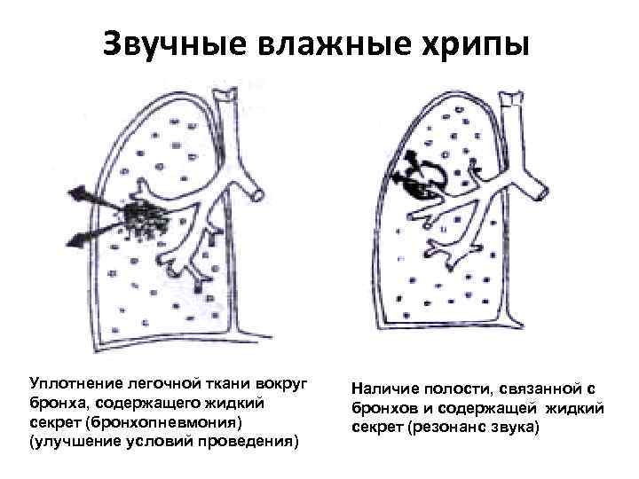 Звучные влажные хрипы Уплотнение легочной ткани вокруг бронха, содержащего жидкий секрет (бронхопневмония) (улучшение условий