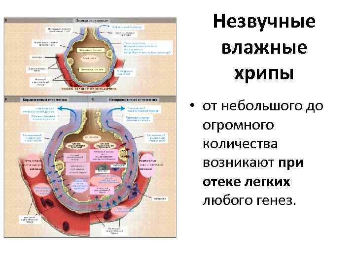 Незвучные влажные хрипы • от небольшого до огромного количества возникают при отеке легких любого