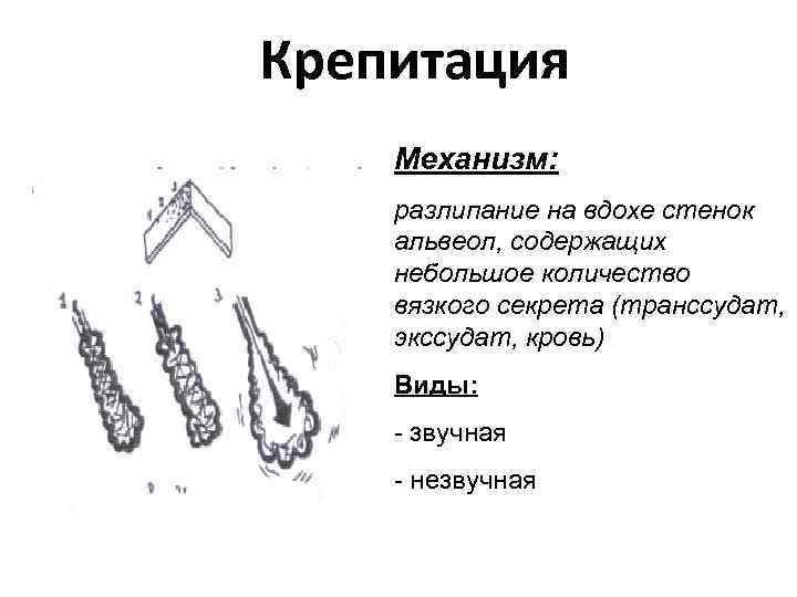 Крепитация Механизм: разлипание на вдохе стенок альвеол, содержащих небольшое количество вязкого секрета (транссудат, экссудат,