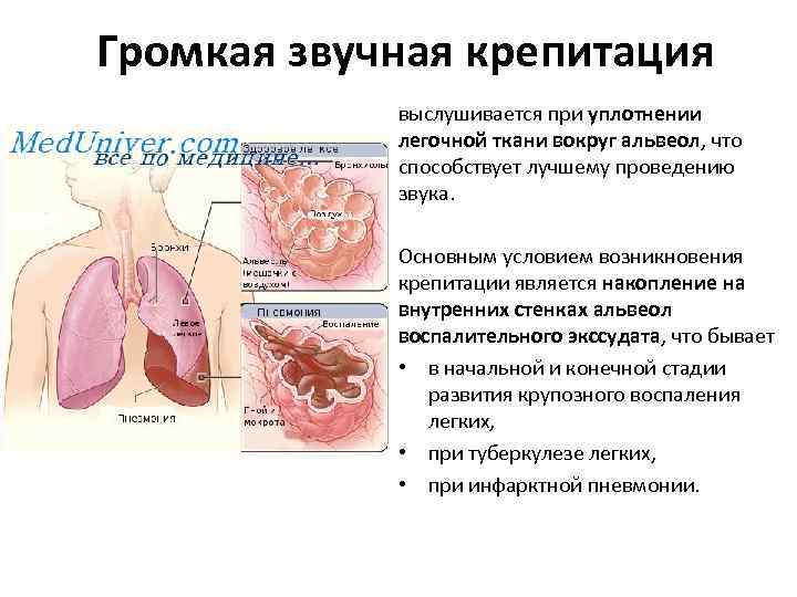 Громкая звучная крепитация выслушивается при уплотнении легочной ткани вокруг альвеол, что способствует лучшему проведению