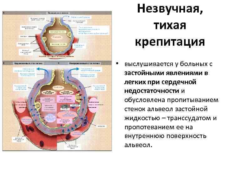 Незвучная, тихая крепитация • выслушивается у больных с застойными явлениями в легких при сердечной