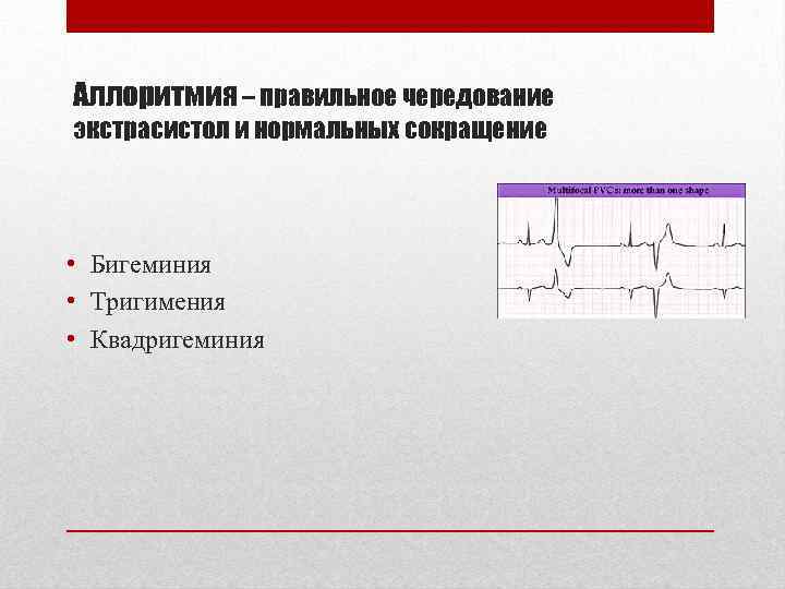 Аллоритмия – правильное чередование экстрасистол и нормальных сокращение • Бигеминия • Тригимения • Квадригеминия