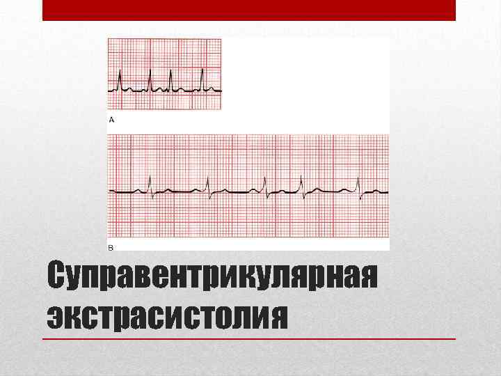 Суправентрикулярная экстрасистолия 