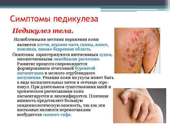 Симптомы педикулеза Педикулез тела. Излюбленными местами поражения кожи являются плечи, верхняя часть спины, живот,
