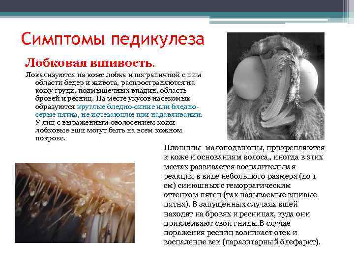 Симптомы педикулеза Лобковая вшивость. Локализуются на коже лобка и пограничной с ним области бедер