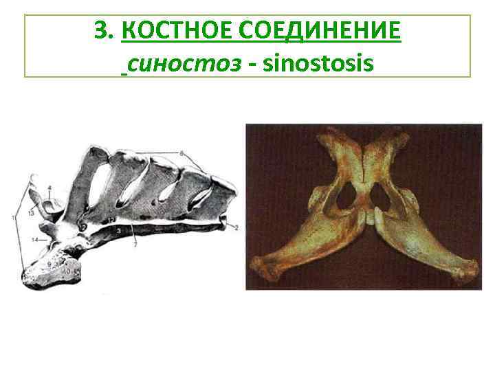 3. КОСТНОЕ СОЕДИНЕНИЕ синостоз - sinostosis 