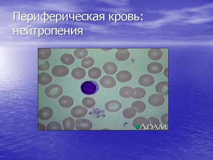 Периферическая кровь: нейтропения 