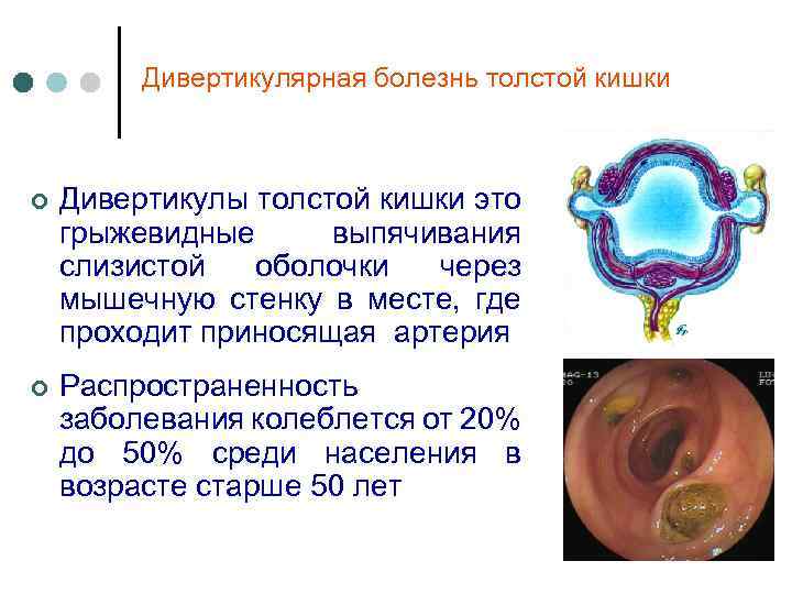 Дивертикулярная болезнь толстой кишки ¢ Дивертикулы толстой кишки это грыжевидные выпячивания слизистой оболочки через