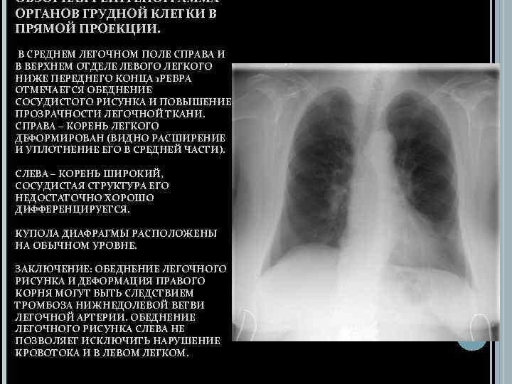 ОБЗОРНАЯ РЕНТГЕНОГРАММА ОРГАНОВ ГРУДНОЙ КЛЕТКИ В ПРЯМОЙ ПРОЕКЦИИ. В СРЕДНЕМ ЛЕГОЧНОМ ПОЛЕ СПРАВА И