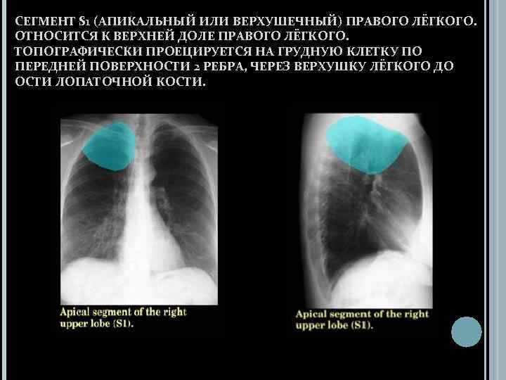 СЕГМЕНТ S 1 (АПИКАЛЬНЫЙ ИЛИ ВЕРХУШЕЧНЫЙ) ПРАВОГО ЛЁГКОГО. ОТНОСИТСЯ К ВЕРХНЕЙ ДОЛЕ ПРАВОГО ЛЁГКОГО.