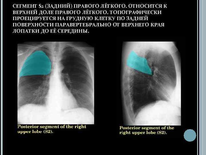 Доли правого легкого