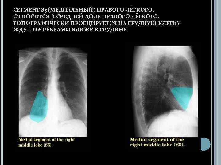 Изменения базальных отделов легких. Сегменты средней доли правого легкого. Доли легкого на рентгенограмме.
