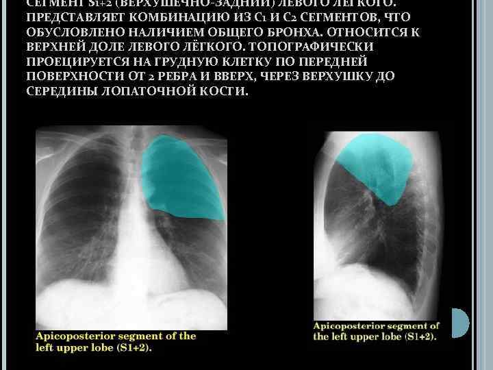 2 сегмент. Дополнительная доля левого легкого. Лобэктомия левого легкого верхней доли. Образование s1\2 левого легкого. S1 2 левого легкого что это.