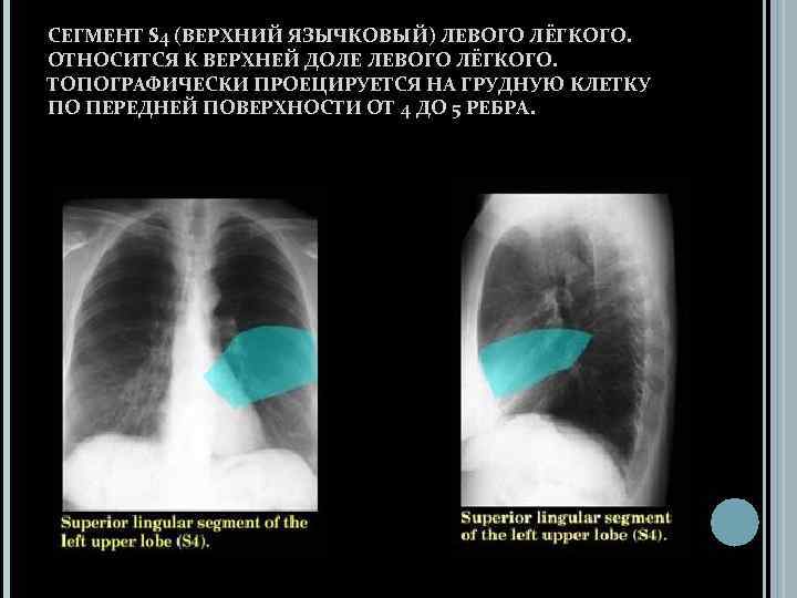 СЕГМЕНТ S 4 (ВЕРХНИЙ ЯЗЫЧКОВЫЙ) ЛЕВОГО ЛЁГКОГО. ОТНОСИТСЯ К ВЕРХНЕЙ ДОЛЕ ЛЕВОГО ЛЁГКОГО. ТОПОГРАФИЧЕСКИ