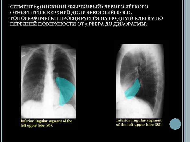 СЕГМЕНТ S 5 (НИЖНИЙ ЯЗЫЧКОВЫЙ) ЛЕВОГО ЛЁГКОГО. ОТНОСИТСЯ К ВЕРХНЕЙ ДОЛЕ ЛЕВОГО ЛЁГКОГО. ТОПОГРАФИЧЕСКИ