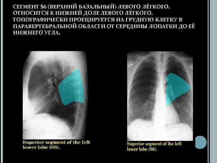 СЕГМЕНТ S 6 (ВЕРХНИЙ БАЗАЛЬНЫЙ) ЛЕВОГО ЛЁГКОГО. ОТНОСИТСЯ К НИЖНЕЙ ДОЛЕ ЛЕВОГО ЛЁГКОГО. ТОПОГРАФИЧЕСКИ