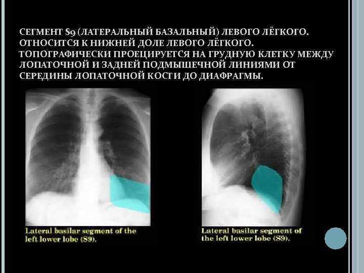 СЕГМЕНТ S 9 (ЛАТЕРАЛЬНЫЙ БАЗАЛЬНЫЙ) ЛЕВОГО ЛЁГКОГО. ОТНОСИТСЯ К НИЖНЕЙ ДОЛЕ ЛЕВОГО ЛЁГКОГО. ТОПОГРАФИЧЕСКИ