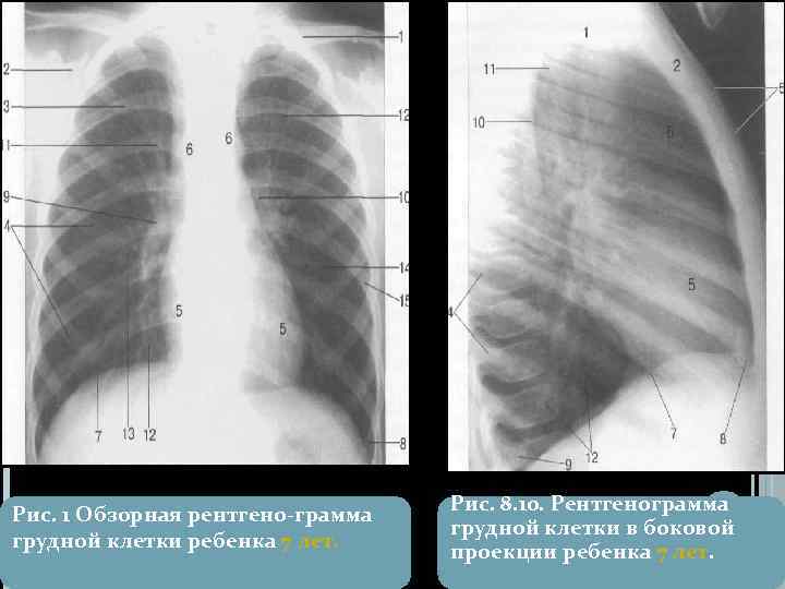 Рис. 1 Обзорная рентгено грамма грудной клетки ребенка 7 лет. Рис. 8. 10. Рентгенограмма