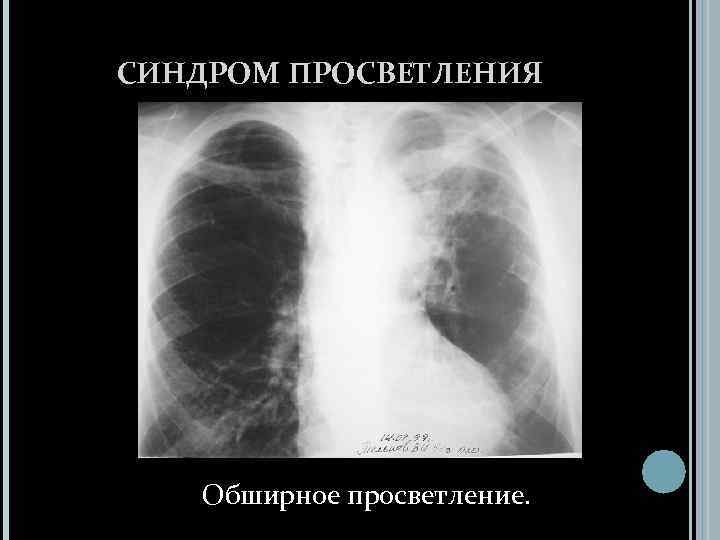 Просветление в легких. Обширное просветление. Синдром обширного просветления рентген. Синдром обширного просветления легочного поля.