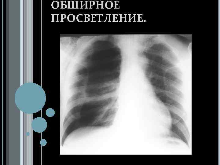 Просветление в легких. Обширное просветление. Просветление на рентгенограмме легких. Ограниченное просветление легочного поля. Обширное просветление легочного поля.