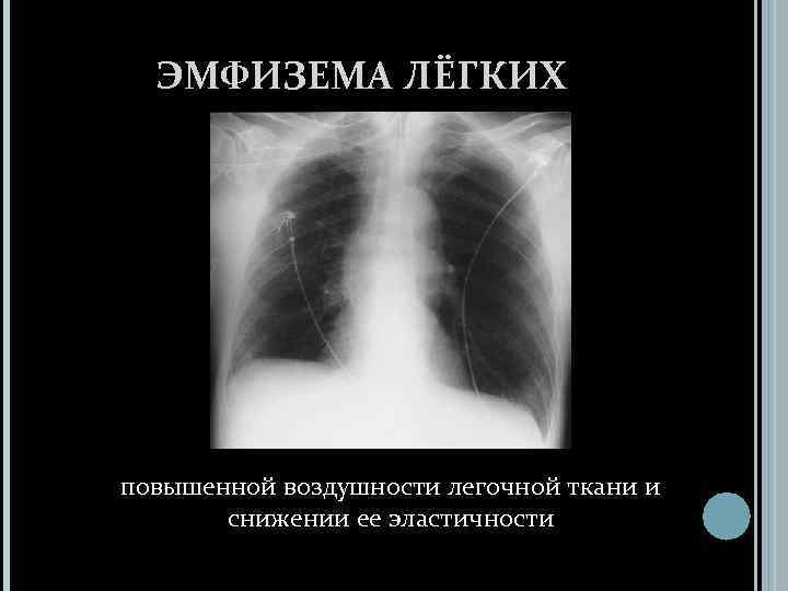 ЭМФИЗЕМА ЛЁГКИХ повышенной воздушности легочной ткани и снижении ее эластичности 