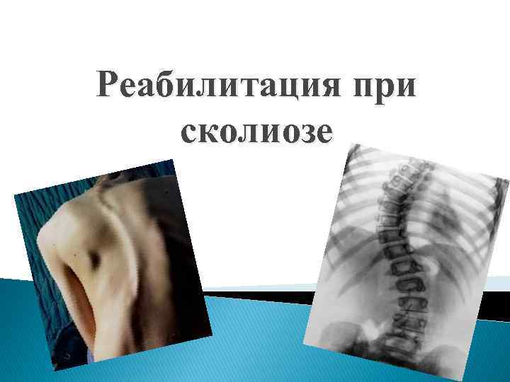 Реабилитация при сколиозе 