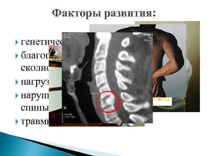 Факторы развития: генетический фактор благоприятствующие развитию сколиоза нагрузочный фактор нарушение регуляции тонуса мышц спины