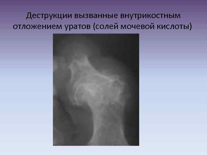 Деструкции вызванные внутрикостным отложением уратов (солей мочевой кислоты) 