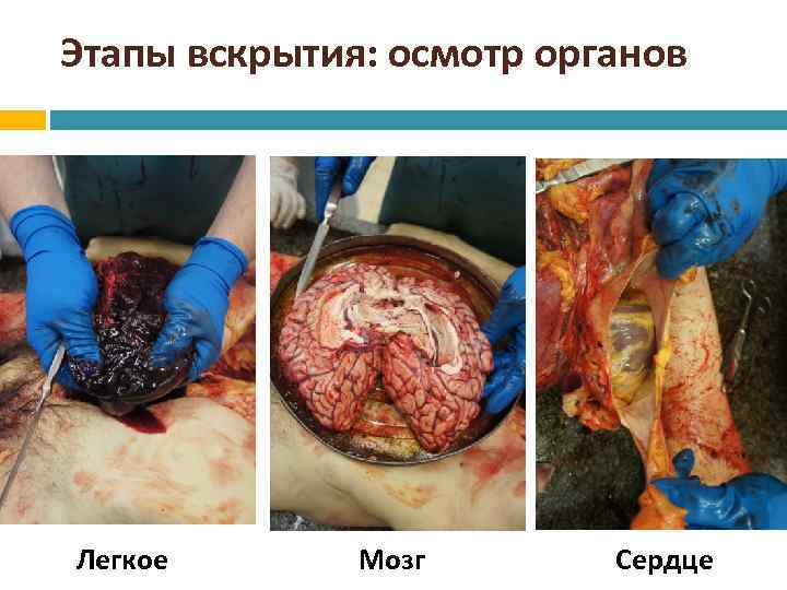 Этапы вскрытия: осмотр органов Легкое Мозг Сердце 