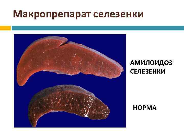 Селезенка первый. Амилоидоз фолликулов селезёнки макропрепарат. Амилоидоз почки макропрепарат. САГОВЫЙ амилоидоз селезенки.