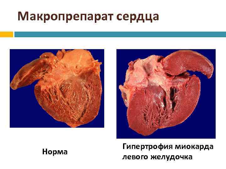 Макропрепарат сердца Норма Гипертрофия миокарда левого желудочка 