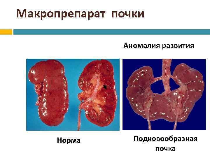 Макропрепарат почки Аномалия развития Норма Подковообразная почка 