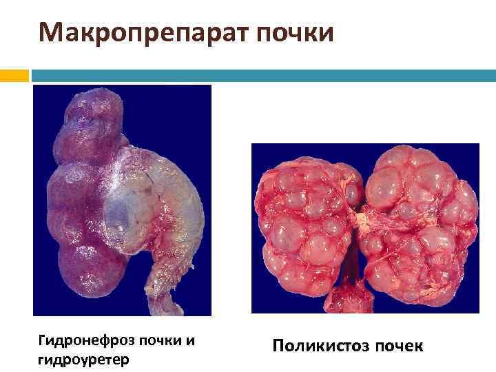 Макропрепарат почки Гидронефроз почки и гидроуретер Поликистоз почек 