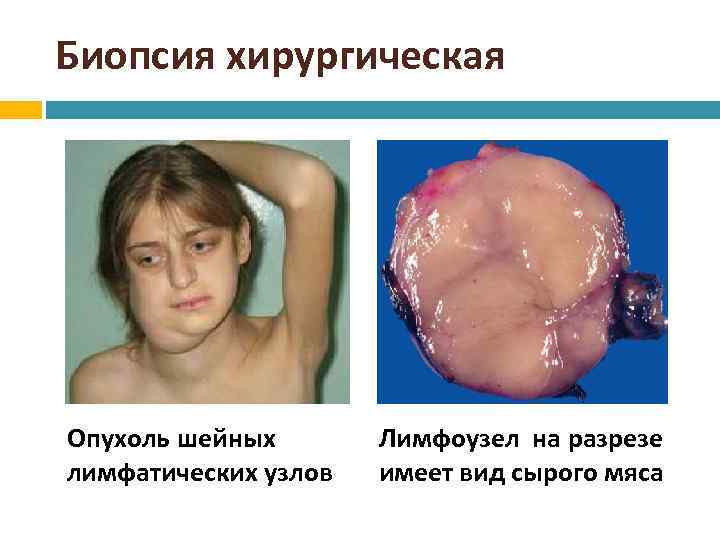 Биопсия хирургическая Опухоль шейных лимфатических узлов Лимфоузел на разрезе имеет вид сырого мяса 26