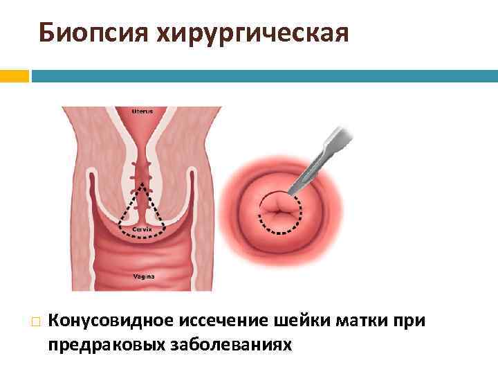 Биопсия шейки матки инструменты