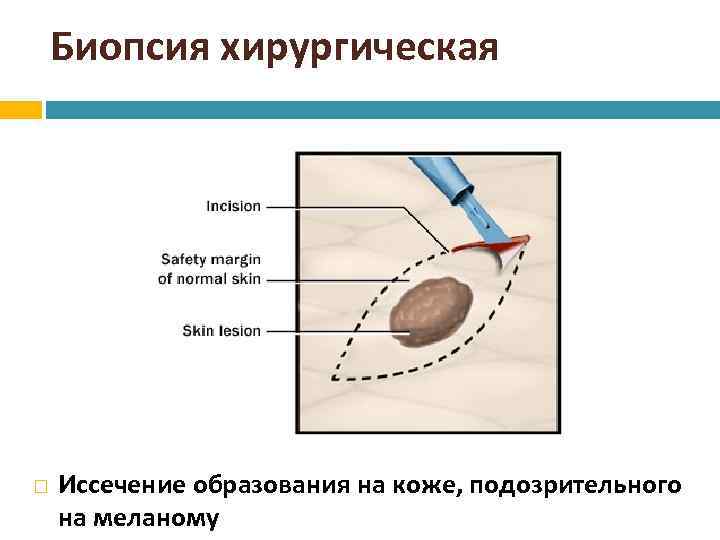Биопсия хирургическая Иссечение образования на коже, подозрительного на меланому 