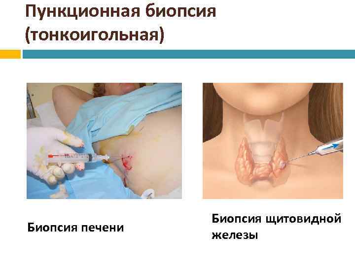 Пункционная биопсия (тонкоигольная) Биопсия печени Биопсия щитовидной железы 