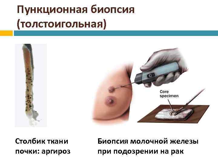 Пункционная биопсия (толстоигольная) Столбик ткани почки: аргироз Биопсия молочной железы при подозрении на рак