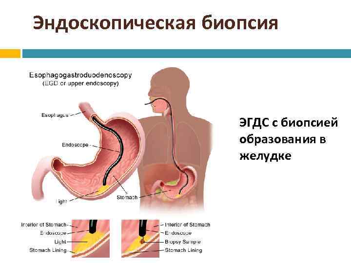 Эндоскопическая биопсия ЭГДС с биопсией образования в желудке 